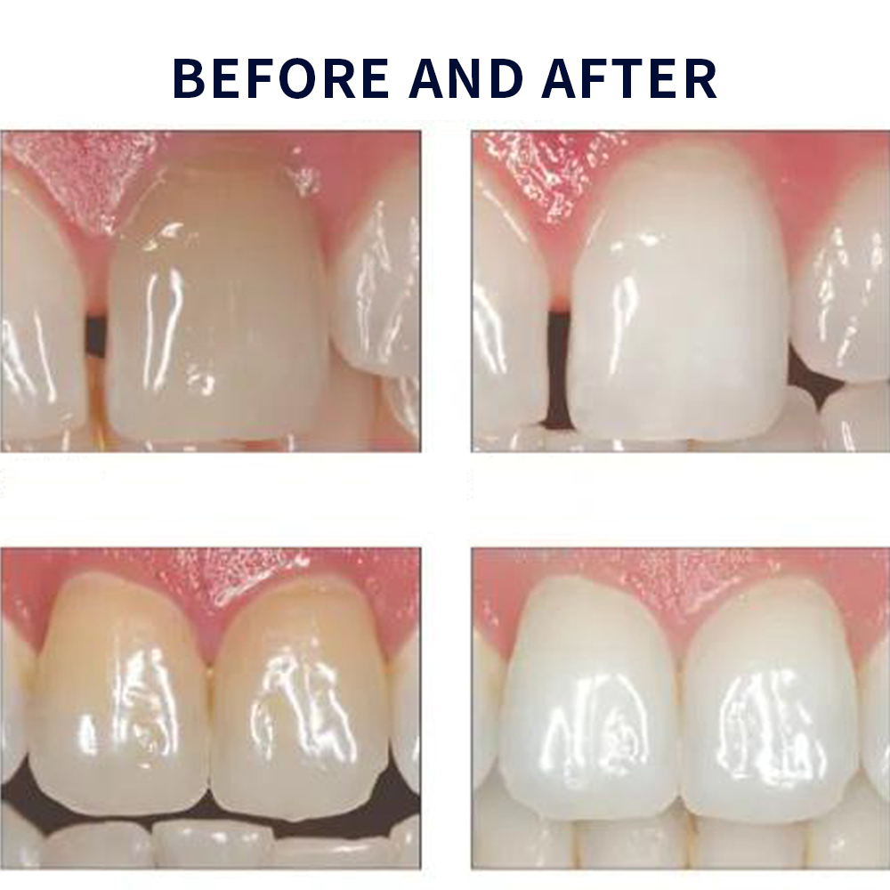 家庭用UV患者セット,プロの衛生機器,紫外線,16%,歯科材 - Teeth Whitening Foam のレビューと価格