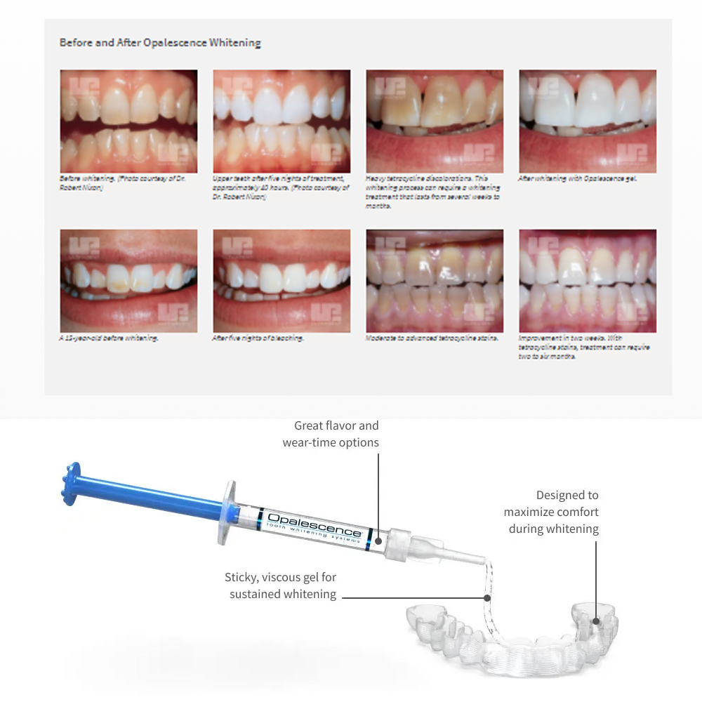 家庭用UV患者セット,プロの衛生機器,紫外線,16%,歯科材 - Teeth Whitening Foam のレビューと価格